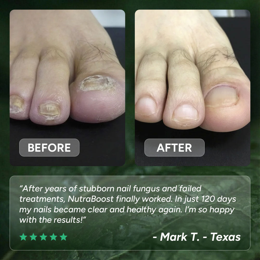 Nail Fungus Treatment Gel